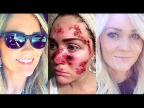 Chính bản thân Willoughby cũng không thể tưởng tượng bức ảnh gương mặt bị tàn phá của mình lại lan truyền chóng mặt như vậy. Tuy nhiên, cô hy vọng nó có thể giúp cứu sống những người khác.