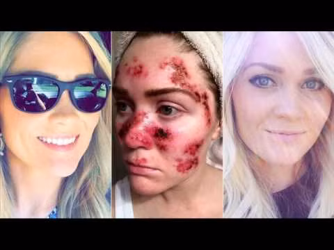 Chính bản thân Willoughby cũng không thể tưởng tượng bức ảnh gương mặt bị tàn phá của mình lại lan truyền chóng mặt như vậy. Tuy nhiên, cô hy vọng nó có thể giúp cứu sống những người khác.