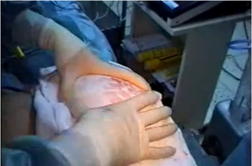 Sau khi nhét vào trong các bác sĩ dùng 1 chiếc khăn đậy lên trên và dùng tay chỉnh để cố định miếng đệm. Ảnh: vietgiatri