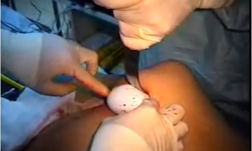 Sau đó bác sĩ tiến hành nhồi nhét miếng độn vào bên trong mông. Ảnh: tinmoi