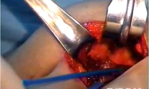 Sau khi phẫu thuật ngoài da, các bác sĩ dùng dụng cụ y tế luồn vào bên trong giúp đẩy cao mông ra ngoài. Ảnh: vietgiaitri