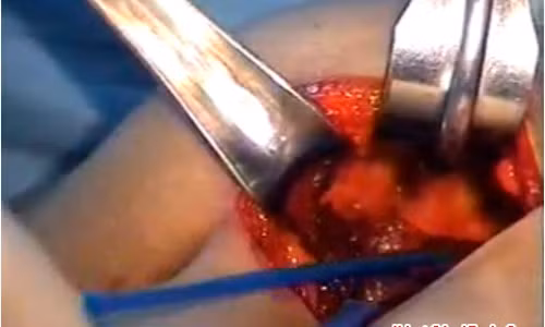 Sau khi phẫu thuật ngoài da, các bác sĩ dùng dụng cụ y tế luồn vào bên trong giúp đẩy cao mông ra ngoài. Ảnh: vietgiaitri