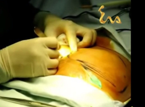 Bước đầu tiên khi làm phẫu thuật độn mông là phải phẫu thuật ngoài da, tạo khoảng trống để tiến hành thao tác ở hai bên mông. Thông thường, bác sĩ sẽ rạch một đường nơi má mông gặp mặt sau của đùi, hoặc các nếp gấp giữa cả hai má. Ảnh: youtube