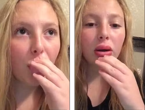 Sau ca bơm môi, bệnh nhân sẽ cảm thấy đau và đôi môi sưng phồng. Sau một thời gian, đôi môi hồi phục, trở nên đầy đặn, gợi cảm. Tuy nhiên có những trường hợp bơm hỏng, đôi môi tạo thành hình ảnh kinh dị có thể dọa ma bất cứ ai. Ảnh: tiin