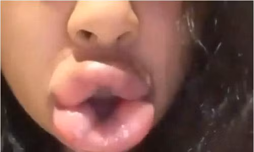 Đôi môi hỏng, sưng vù và mọng đỏ lên vì bị dồn máu. Ảnh: vietgiaitri