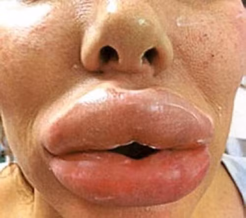 Thậm chí còn xuất hiện nhiều vết bầm tím trên môi. Ảnh: phunutoday