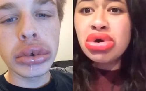 Đôi môi sưng tấy, bầm tím trông như một thảm họa trước mặt người đối diện. Ảnh: trithuctre