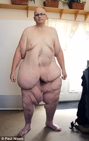 Cuối cùng, anh đã phải bỏ công việc đưa thư vì quá nặng nề không thể di chuyển được. Sau đó một vài năm, cân nặng tăng vọt bất thường, anh Manson không thể di chuyển, chỉ có thể nằm một chỗ và phải có người chăm sóc.