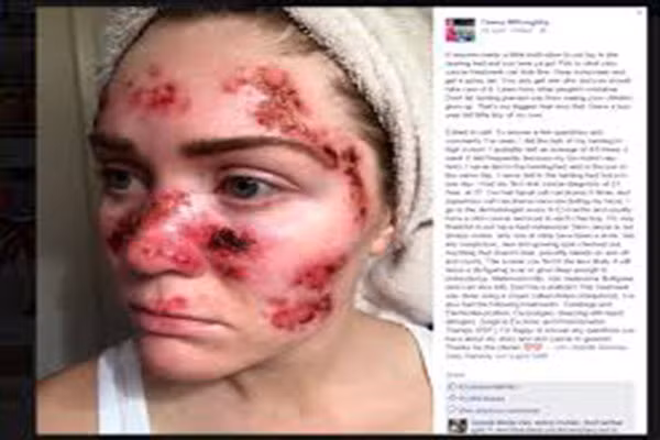 Sau đó, cô đã đăng tải lên Facebook hình ảnh ung thư da với gương mặt đầy vết sẹo và lở loét rỉ máu. Bức ảnh này kèm dòng chú thích "Nếu ai đó cần một chút động lực để không nằm trên giường tạo nắng nhân tạo nhuộm da thì hãy nhìn vào đây! Điều trị ung thư da trông như thế này đây".