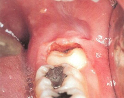 Với trường hợp răng khôn mọc ngầm trong xương hàm, bệnh nhân phải trải qua cuộc tiểu phẫu mở nướu để nhổ. Sau đó đóng vạt nướu lại là có thể hoàn tất điều trị. Tuy nhiên, nếu răng mọc sâu bên trong và lệch, chéo thì việc phẫu thuật khá phức tạp. Ảnh: media