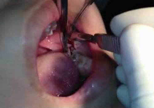 Để cắt lợi trùm, bác sĩ phải bơm rửa, sát trùng, gây tê tại chỗ. Sau đó bóc tách toàn bộ mặt nhai răng 8. Dùng panh kẹp đúng điểm giữa bờ lợi trùm để cố định lợi trùm không di động khi cắt. Kết thúc bác sĩ khâu phục hồi bằng mũi khâu treo nhằm tạo bám dính mới ở mặt xa răng 8. Ảnh: nhakhoa