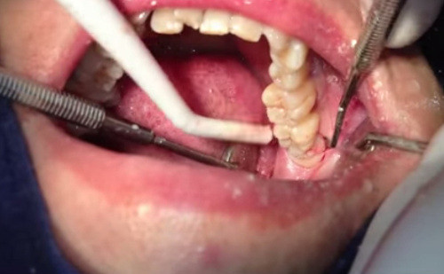 Sau đó, bác sĩ sẽ tiến hành tách nướu, nhổ hết chân răng đảm bảo không làm gãy hoặc sót lại. Vết rạch nướu được khâu lại bằng chỉ thẩm mỹ nha khoa tự tiêu. Sau khi quy trình nhổ răng hoàn tất và thuốc tê hết tác dụng sau 24 giờ có thể bạn sẽ còn cảm giác hơi nhức. Ảnh: youtube