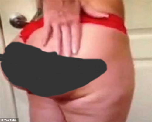 Sau ca phẫu thuật, mông của bệnh nhân sẽ bị sưng vù và rất đau đớn. Ảnh: youtube