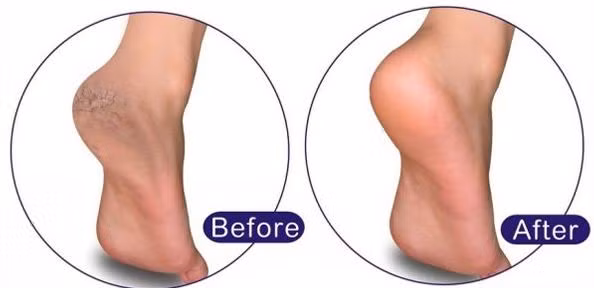 Bạn có thể thực hiện liệu pháp này từ 1 đến 2 lần/tuần, trước khi đi ngủ. Khi tình trạng khô nứt chân đã được cải thiện, bạn có thể thực hiện 2 lần/tháng trong suốt mùa hè. Chúc bạn có đôi chân mềm mại như ý! 