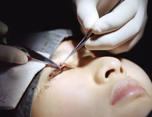 Bác sĩ tiến hành cắt bỏ da thừa, mỡ thừa mí mắt bằng các dụng cụ y khoa và đồng thời cầm máu bằng phương pháp đốt điện lên vùng chảy máu nhằm hạn chế tổn thương niêm mạc. Ảnh: phununew