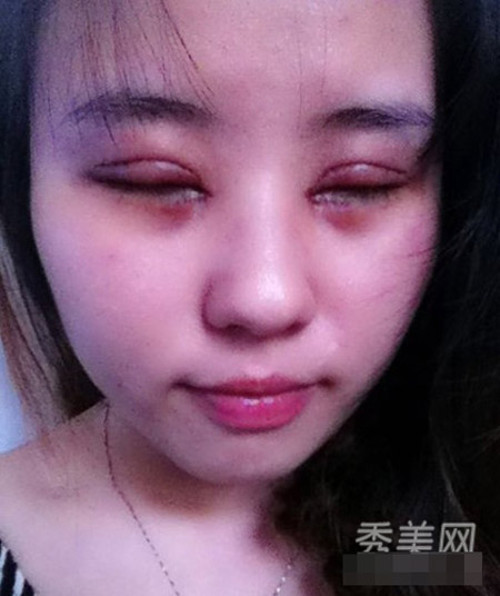 Sau phẫu thuật, mắt bệnh nhân sẽ sưng húp đến ghê sợ. Ảnh: xinhuanet