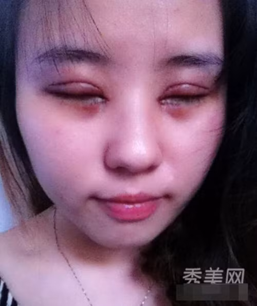 Sau phẫu thuật, mắt bệnh nhân sẽ sưng húp đến ghê sợ. Ảnh: xinhuanet