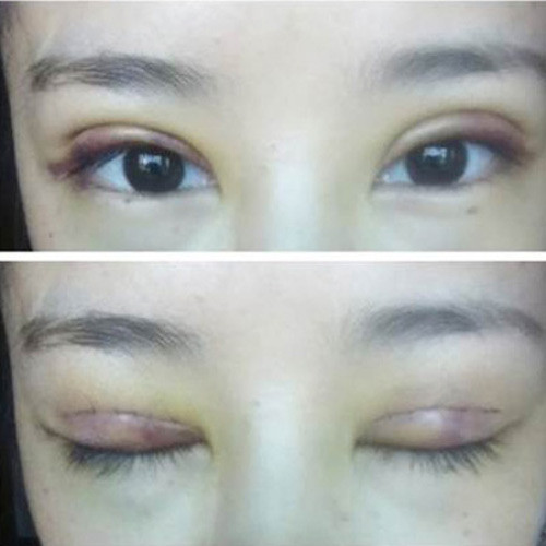 Mắt có thể bị mờ hoặc nhạy cảm với ánh sáng. Ảnh: khampha