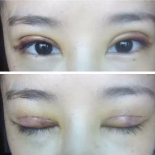 Mắt có thể bị mờ hoặc nhạy cảm với ánh sáng. Ảnh: khampha