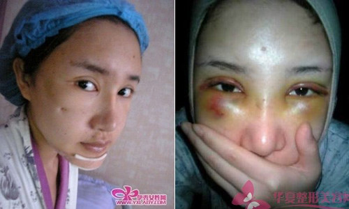 Những vết bầm tím sẽ xuất hiện quanh vùng mắt. Ảnh: sina