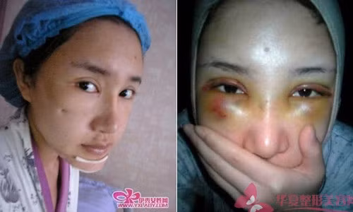 Những vết bầm tím sẽ xuất hiện quanh vùng mắt. Ảnh: sina