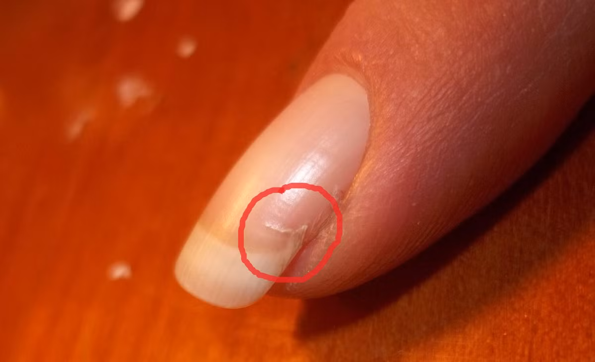 Móng nứt. Nếu móng tay của bạn thường xuyên bị nứt, điều này chứng tỏ cơ thể của bạn đang bị thiếu axit folic, vitamin C và protein.