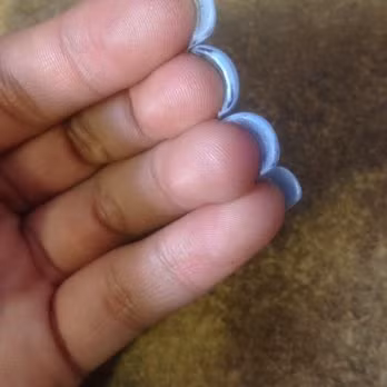 Móng tay dày lên bất thường. Nếu móng tay của bạn dày bất thường, có thể bạn đang có vấn đề về phổi. Nó cũng có thể chỉ ra rằng cơ thể của bạn đang kém lưu thông. Móng tay dày cũng có thể cho biết bạn đang bị nhiễm trùng nấm men. 