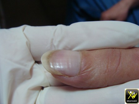 Móng tay với nhiều rãnh nhỏ. Triệu chứng này có thể chỉ ra rằng bạn đang bị bệnh vảy nến., một chứng bệnh tự miễn dịch và là nguyên nhân gây rụng tóc.