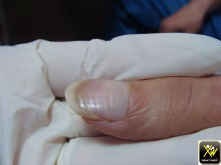 Móng tay với nhiều rãnh nhỏ. Triệu chứng này có thể chỉ ra rằng bạn đang bị bệnh vảy nến., một chứng bệnh tự miễn dịch và là nguyên nhân gây rụng tóc.