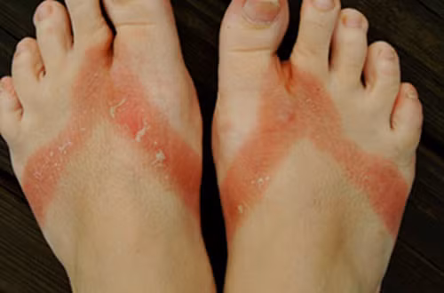 Chấn thương. Với trẻ em và thanh thiếu niên, đặc biệt có nguy cơ chấn thương nếu mang dép tông thường xuyên. Không chỉ hại đến cấu trúc xương, những người thường đi tông còn dễ bị vết cắt, vết xước, bong gân, chảy máu và mụn cóc, trơn trượt ngã.