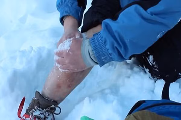 Dùng tuyết gây tê mổ chân ngay trên núi. Một nhà leo núi người Nga đã tiến hành tự mổ cho mình khi một cục băng rơi xuống chân gây chấn thương khiến anh không thể đi lại.