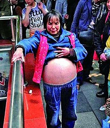 Tự mổ bụng để tiết kiệm chi phí. Bà Wu Yuanbi, 53 tuổi được chẩn đoán mắc bệnh lạ khiến bụng phình to. Do gia đình không có điều kiện mà bà đã thực hiện quyết định nguy hiểm là tự mổ bụng cho mình.