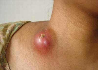 Đến nay, y học thế giới vẫn chưa biết chính xác nguyên nhân trực tiếp gây ung thư tuyến mồ hôi. Qua nhiều nghiên cứu, các nhà khoa học nhận thấy, bệnh có liên quan đến tia cực tím (UV - khi tia này tiếp xúc với phần da gây ra hiện tượng suy giảm miễn dịch của da nơi tiếp xúc). Hoặc do bệnh nhân sử dụng thuốc kháng viêm, thuốc điều trị viêm khớp trong thời gian dài.