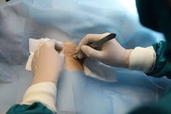 Khác với các loại ung thư, ung thư tuyến mồ hôi thường không nhạy cảm với hóa trị, xạ trị. Do vậy cách tốt nhất để chữa trị là phẫu thuật. Bệnh nhân sẽ được cắt bỏ bướu nguyên phát hoặc nạo vét sạch hạch di căn.