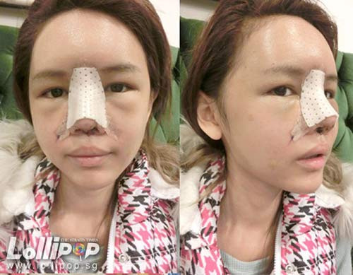 Không chỉ bị sưng, nhiều vết bấm tím đáng sợ cũng xuất hiện trên khuôn mặt. Ảnh: megafun