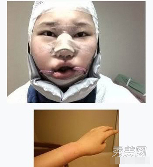 Sau khi hoàn tất quy trình sửa mũi, bác sĩ sẽ khâu vết mổ bằng chỉ khâu thẩm mỹ. Sau phẫu thuật, mũi sẽ không có vết sẹo. Tuy nhiên,việc mũi bị sưng là điều không thể tránh khỏi. Ảnh: khampha