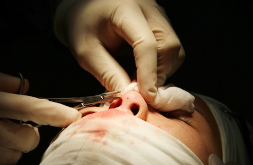 Trước khi phẫu thuật, bác sĩ phải đưa miếng bông nhỏ vào lỗ mũi để ngăn máu chảy vào lỗ mũi. Để tạo khoang mũi, bác sĩ rạch một đường bên rìa mũi và đưa miếng sụn nhân tạo vào. Ảnh: thammymui