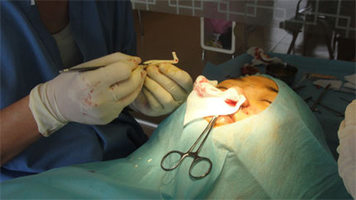 Nếu miếng sụn chưa vừa với bệnh nhân, bác sĩ tiến hành cắt, gọt, cho phù hợp. Ảnh vtc