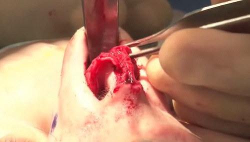 Có những trường hợp, bác sĩ phải đưa từng nhát kéo nhẹ nhàng cắt tỉa sụn phía trong đầu mũi. Ảnh: youtube