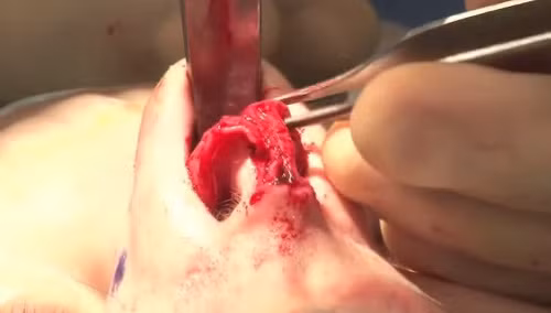 Có những trường hợp, bác sĩ phải đưa từng nhát kéo nhẹ nhàng cắt tỉa sụn phía trong đầu mũi. Ảnh: youtube