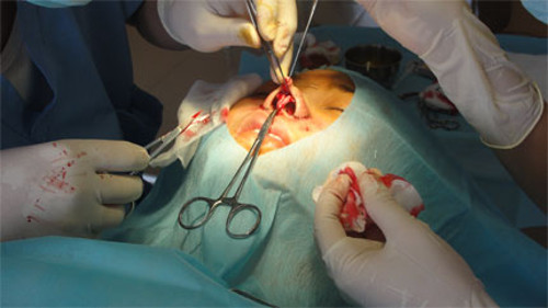 Với những người mũi to, bác sĩ còn phải cắt bỏ phần cánh mũi, thủ phạm khiến mũi to. Sau đó khâu sát phần cánh mũi với da mặt. Ảnh: vietbao