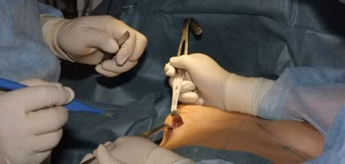 Ngày nay, phẫu thuật nâng ngực không còn xa lạ với chị em phụ nữ trên toàn thế giới. Với công nghệ phẫu thuật thẩm mỹ hiện đại, phẫu thuật nâng ngực được xem là phương pháp nhanh nhất giúp chị em từ 'màn hình phẳng' sở hữu vòng một hoàn hảo. Ảnh: megafun