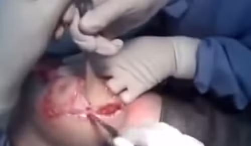 Tuy vậy, trải qua ca phẫu thuật nâng ngực không hề nhẹ nhàng. Trước khi phẫu thuật, bệnh nhân sẽ được gây mê. Sau đó bác sĩ dùng dao mổ rạch theo nét vẽ. Ảnh: youtube