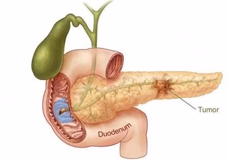 Ung thư đoạn trên ống mật sẽ xuất hiện triệu chứng vàng da ở giai đoạn sớm hoặc giai đoạn giữa, ung thư ở đoạn cuối đường mật vàng da sẽ xuất hiện vào giai đoạn tương đối muộn. Những bệnh nhân gặp triệu chứng này có thể tiến hành siêu âm để chẩn đoán bệnh.