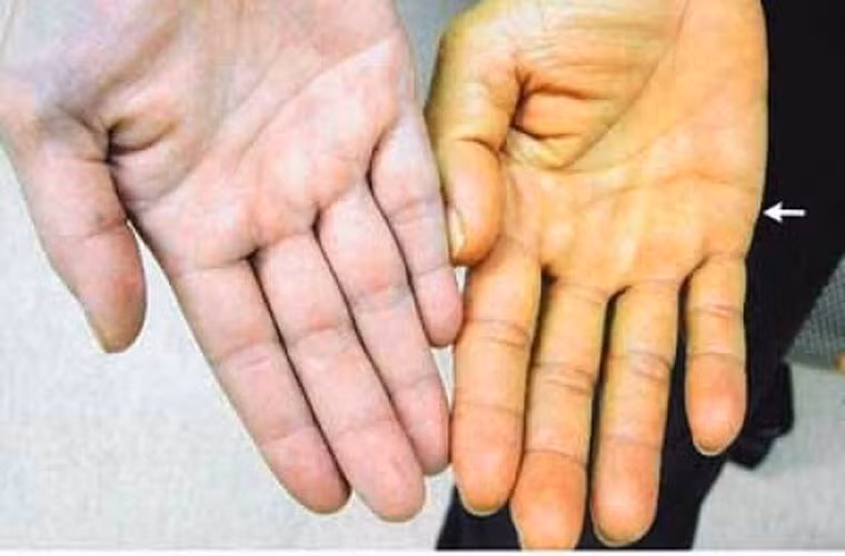 Vàng da. Là triệu chứng sớm nhất và quan trọng nhất. Ước tính có khoảng 90% đến 98% bệnh nhân ung thư ống dẫn mật ở các giai đoạn khác nhau. Dấu hiệu này có mức độ nhiễm vàng khác nhau ở da và võng mạc. Đặc điểm của vàng da là đậm dần theo sự phát triển của bệnh, không đau, một số ít bệnh nhân có biểu hiện vàng da không ổn định.