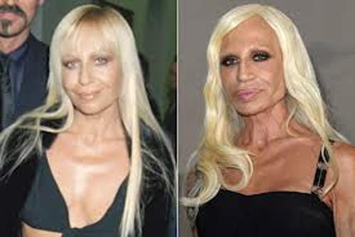 Donatella Versace. Nhà thiết kế thời trang Italia, Phó tổng giám đốc tập đoàn danh tiếng Versace, Donatella Versace là một trong những nạn nhân của việc lạm dụng dao kéo. Trước đây, khuôn mặt Versace không có gì sắc nét nhưng dễ nhìn. Bà đã tốn khá nhiều tiền vào việc nâng mũi, bơm môi, căng da mặt, tiêm chất độn và botox. Sự phá hoại của dao kéo khiến thân hình người phụ nữ này trở thành tàn tạ. Ảnh: vnpt