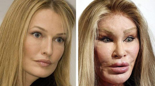 Jocelyn Wildenstein, một nhà xã hội tại New York, là một ví dụ điển hình về khuôn mặt thảm họa sau khi phẫu thuật. Trải qua nhiều năm dao kéo, khuôn mặt người phụ nữ này biến dạng một cách khó tưởng tượng. Cô không tiếc chỉ một khoản tiền khổng lồ vào phẫu thuật để rước lấy khuôn mặt sưng vù, như một “quái nhân. Ấy vậy mà, cô luôn thấy mình đẹp và hài lòng với hình dạng của mình trong gương. Ảnh: edaily 