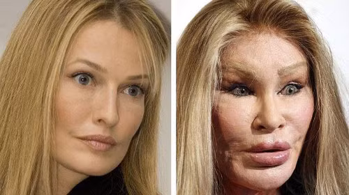 Jocelyn Wildenstein, một nhà xã hội tại New York, là một ví dụ điển hình về khuôn mặt thảm họa sau khi phẫu thuật. Trải qua nhiều năm dao kéo, khuôn mặt người phụ nữ này biến dạng một cách khó tưởng tượng. Cô không tiếc chỉ một khoản tiền khổng lồ vào phẫu thuật để rước lấy khuôn mặt sưng vù, như một “quái nhân. Ấy vậy mà, cô luôn thấy mình đẹp và hài lòng với hình dạng của mình trong gương. Ảnh: edaily 