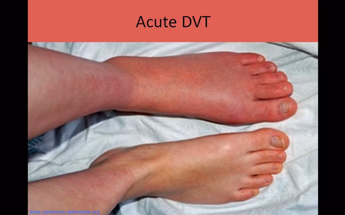 Da xuất hiện màu bất thường. Các cục máu đông sẻ cản trở việc lưu thông máu khiến da nhợt nhạt hoặc mất màu một cách bất thường. Hoặc nếu như da chuyển thành màu đỏ hoặc màu tím là dấu hiệu của bệnh này. Ảnh: Ultrasound Registry Review.