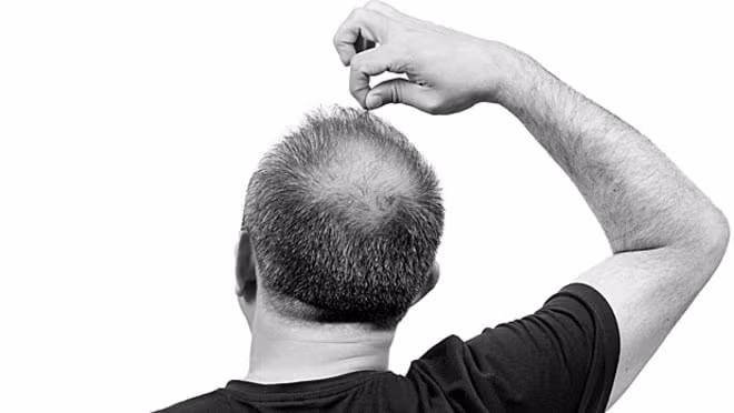 Khi sợi tóc bị mọc ngược vào trong, nó gây ra hiện tượng ngứa ngáy và khiến mụn nhọt có cơ hội xuất hiện. (Nguồn Mensjournal)